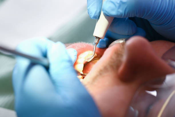Best Broken or Cracked Tooth Emergency Dentist in Alexandria Bay, NY